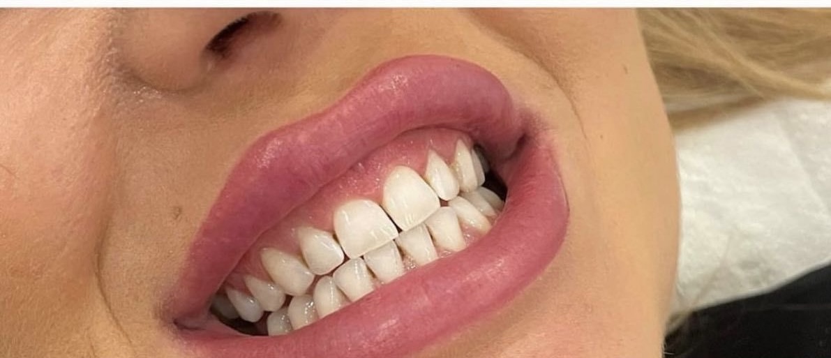 Résultat blanchiment dentaire