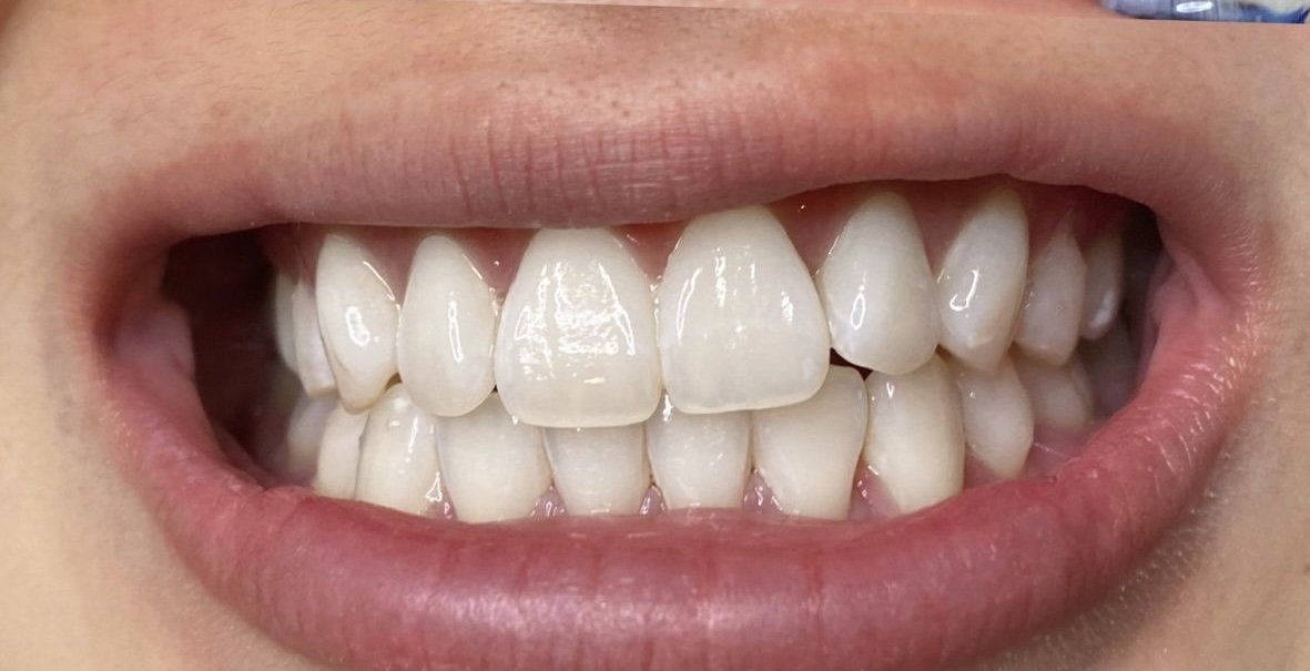 Résultat blanchiment intensif